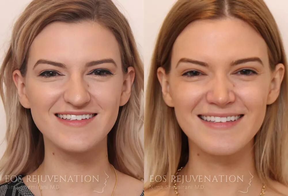 Rhinoplasty Before & After