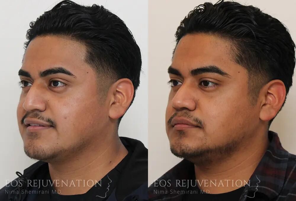 Rhinoplasty Before & After