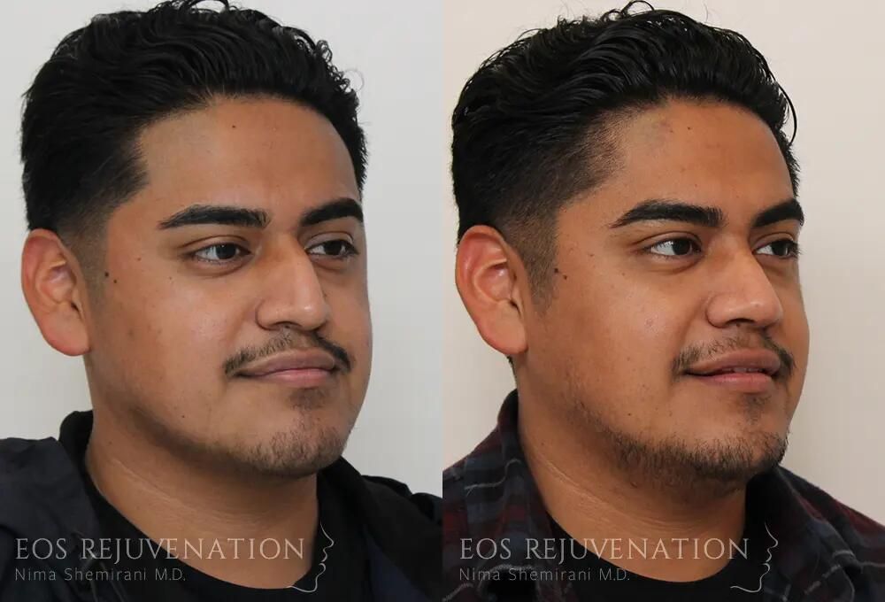 Rhinoplasty Before & After