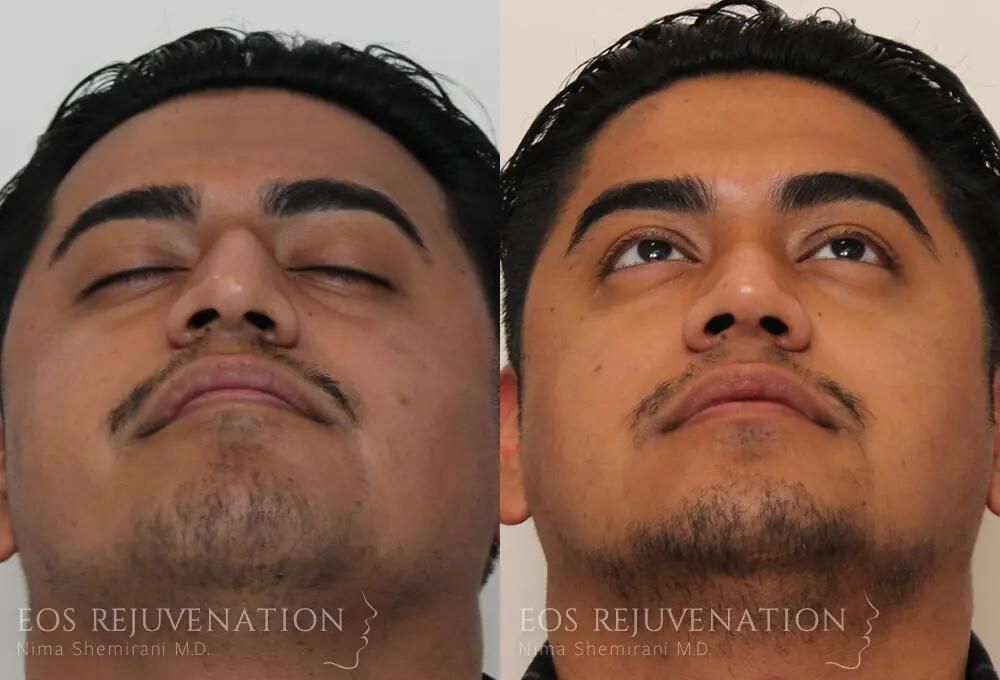 Rhinoplasty Before & After