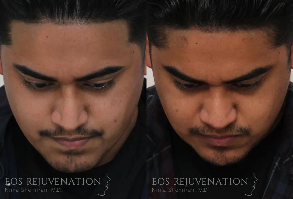 Rhinoplasty Before & After