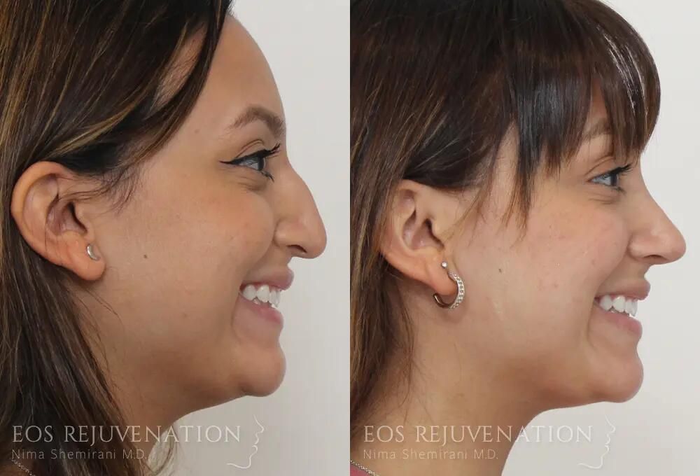 Rhinoplasty Before & After