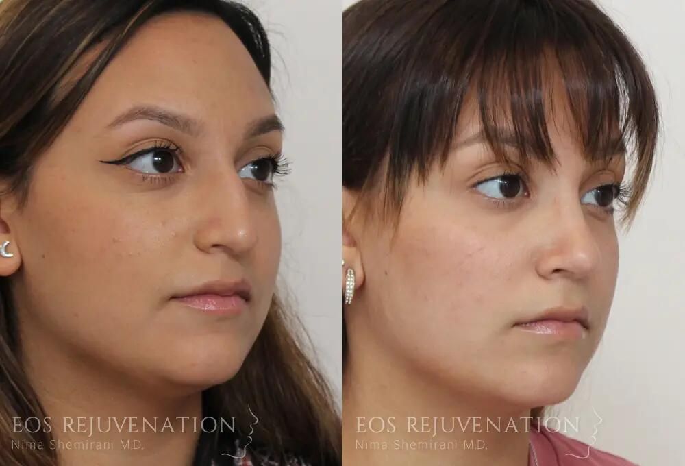 Rhinoplasty Before & After