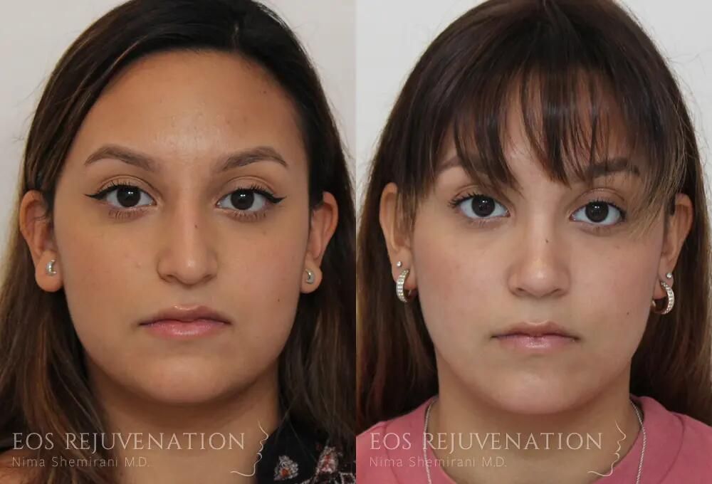 Rhinoplasty Before & After