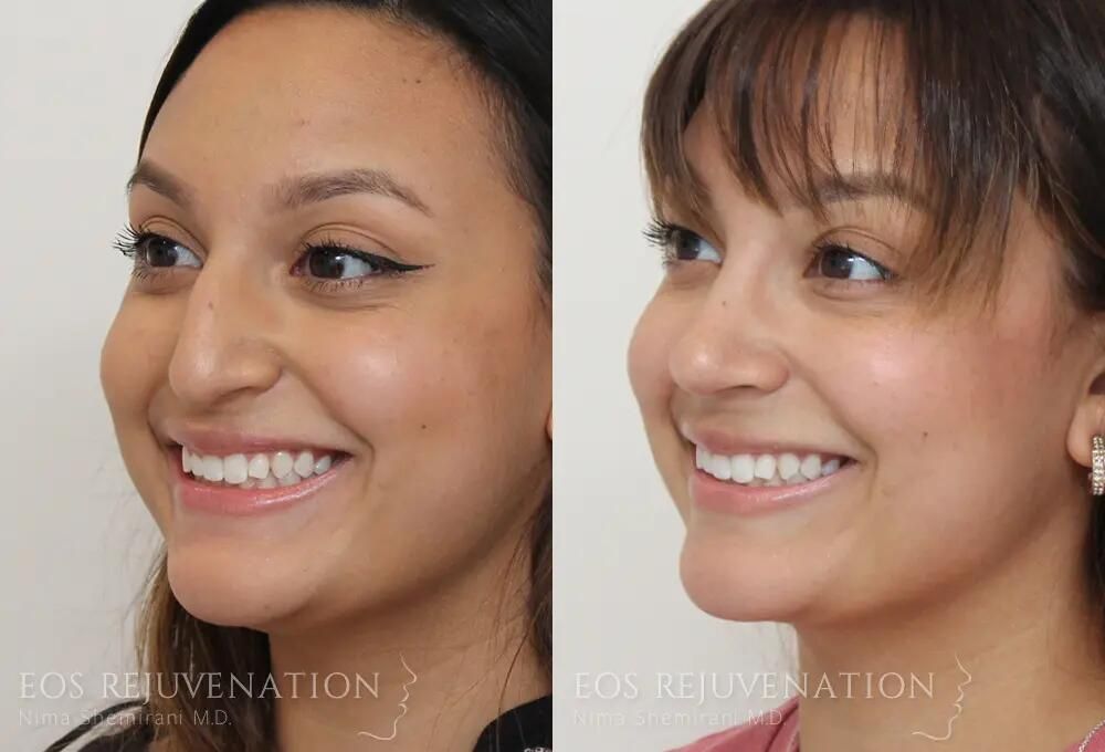 Rhinoplasty Before & After