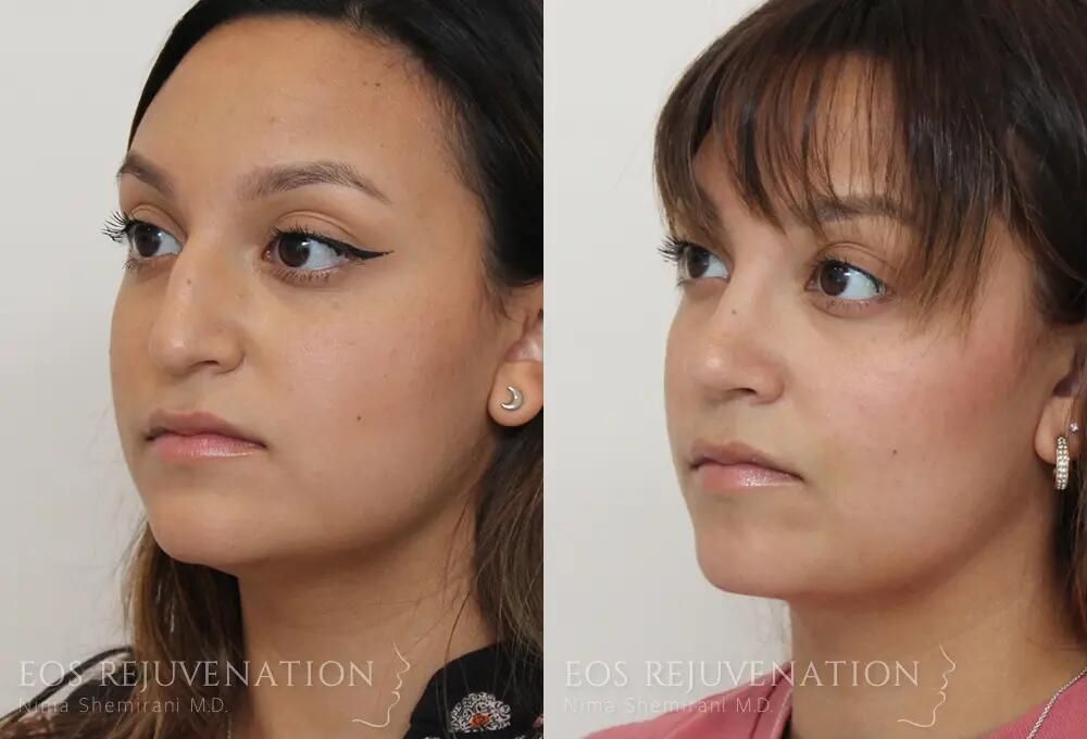 Rhinoplasty Before & After