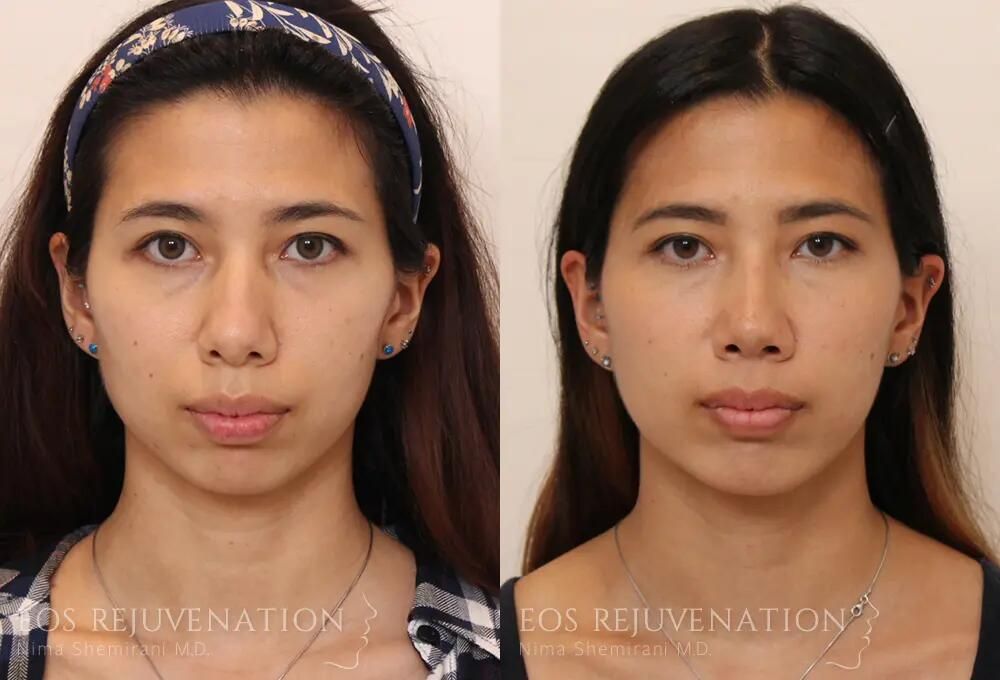 Rhinoplasty Before & After