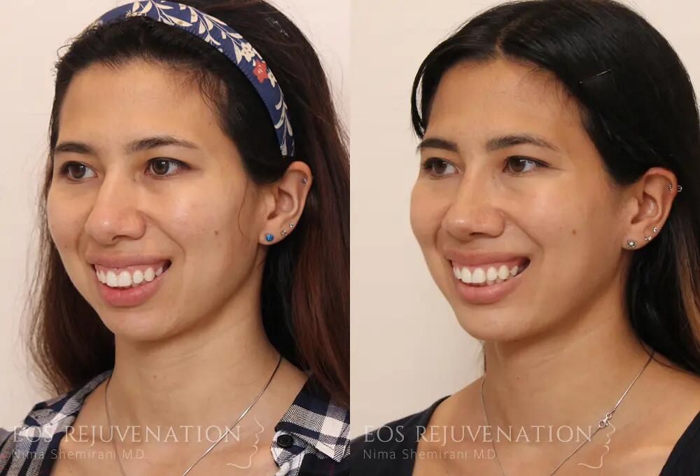 Rhinoplasty Before & After