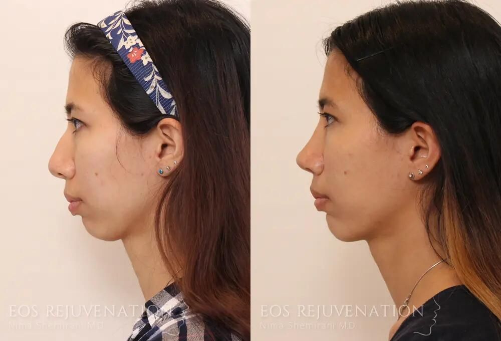 Rhinoplasty Before & After