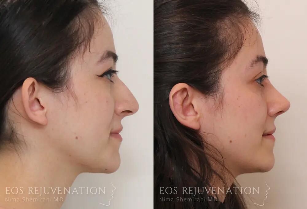 Rhinoplasty Before & After