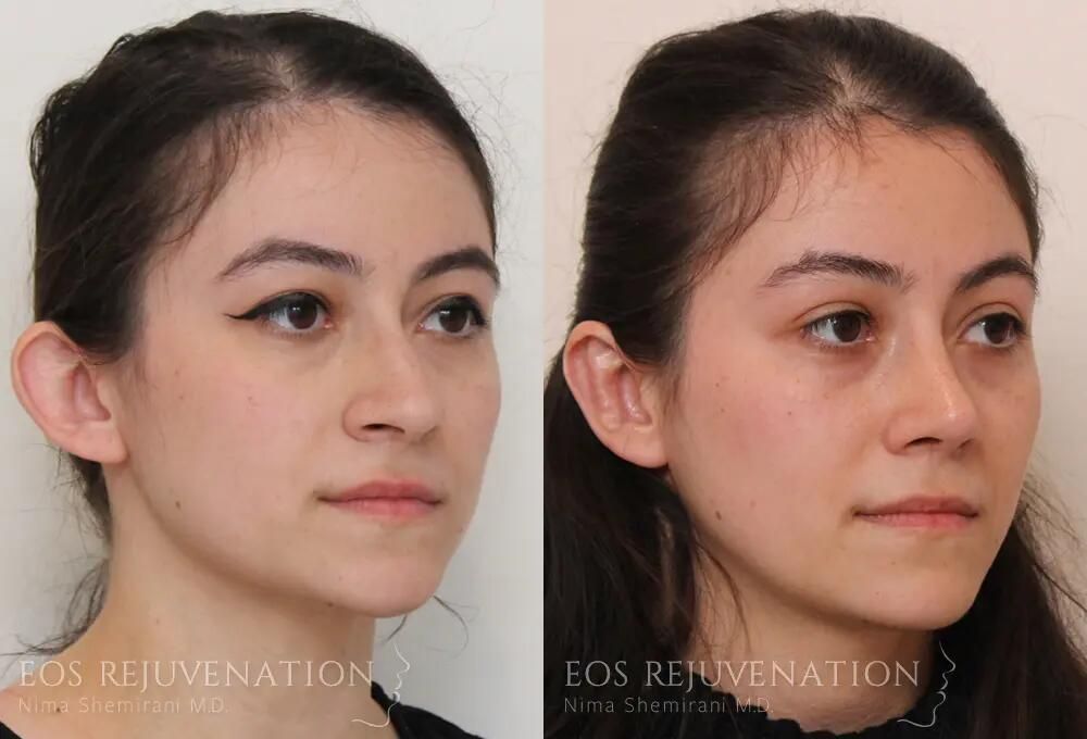 Rhinoplasty Before & After