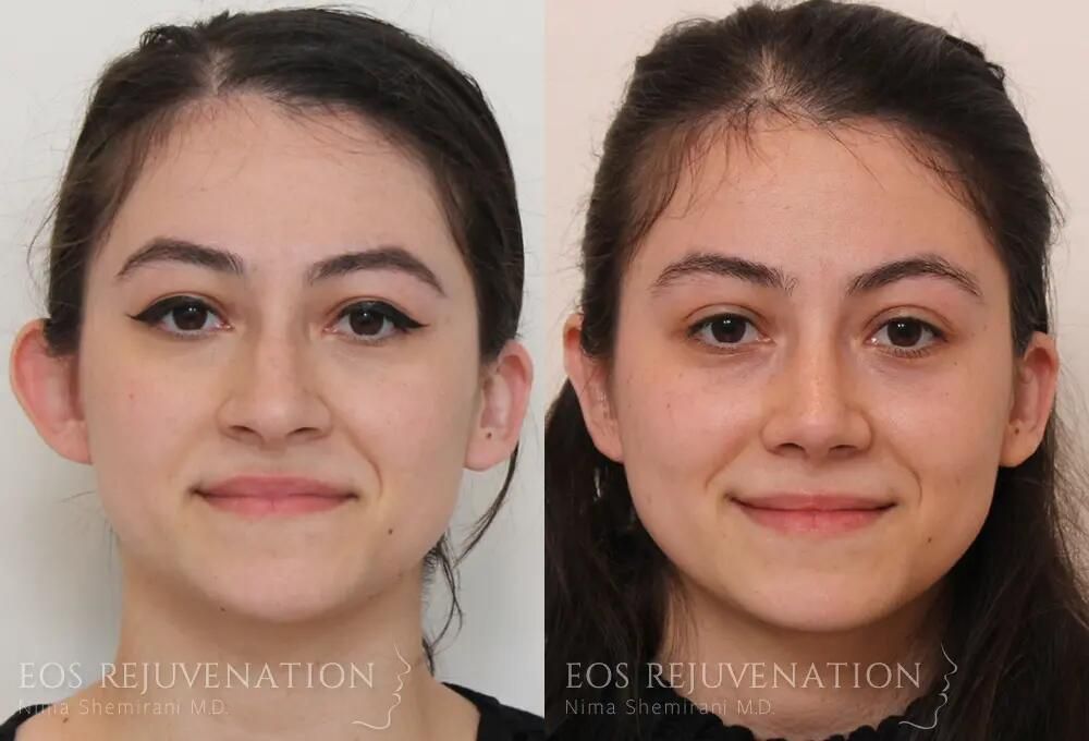 Rhinoplasty Before & After