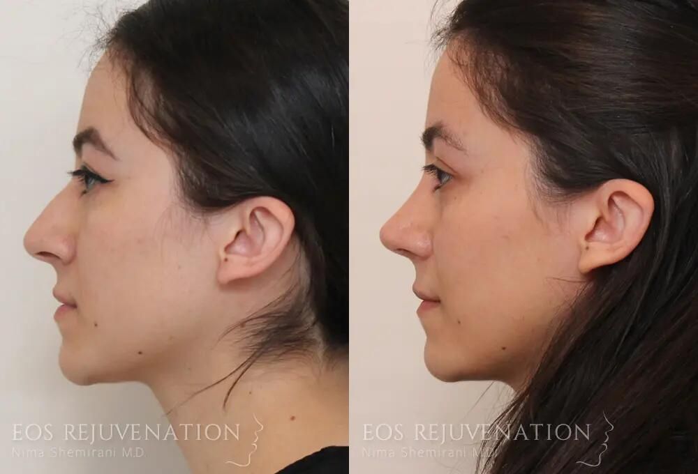 Rhinoplasty Before & After