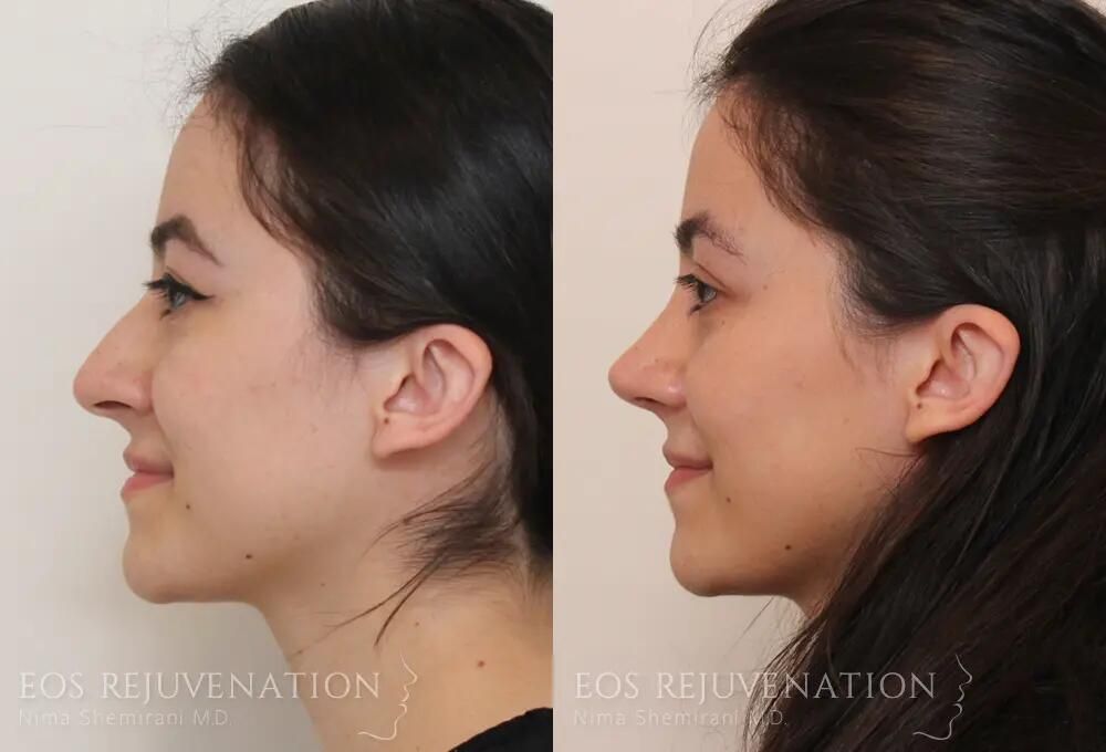 Rhinoplasty Before & After