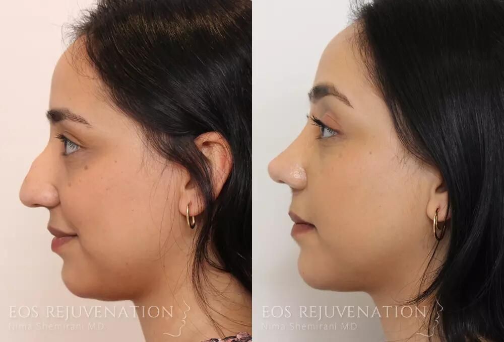 Rhinoplasty Before & After