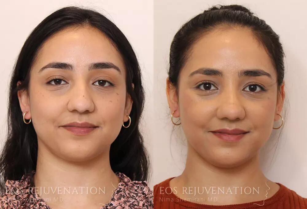 Rhinoplasty Before & After