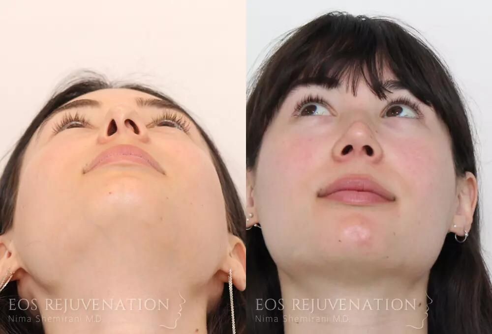 Rhinoplasty Before & After