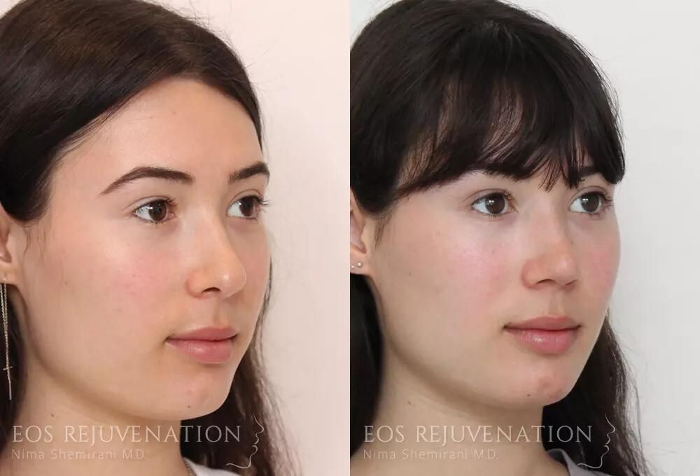Rhinoplasty Before & After