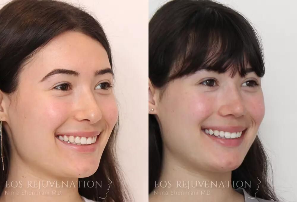 Rhinoplasty Before & After