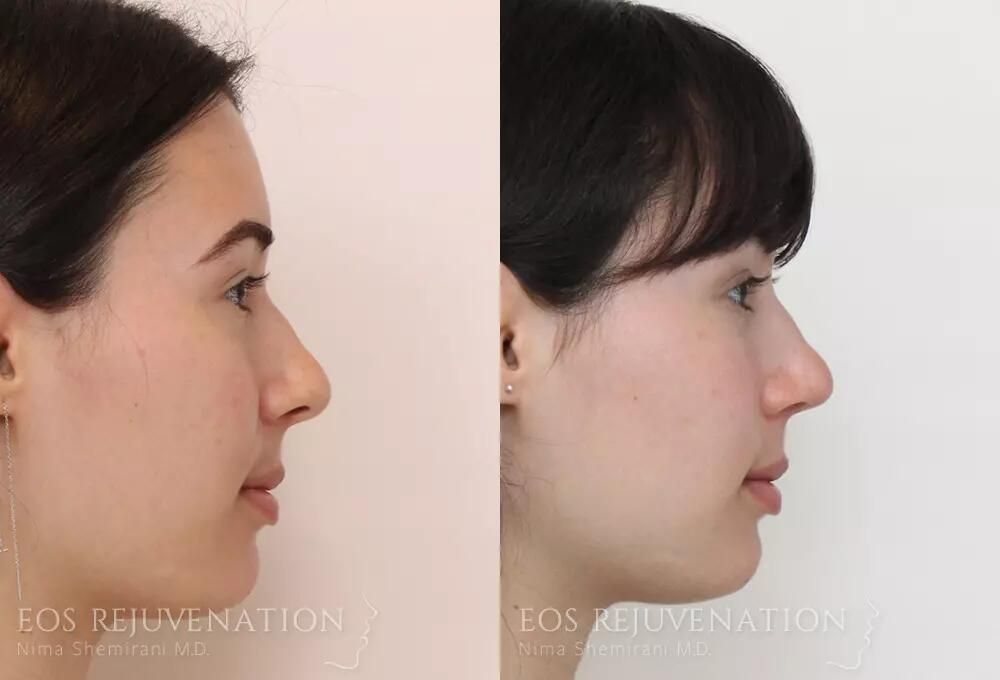 Rhinoplasty Before & After
