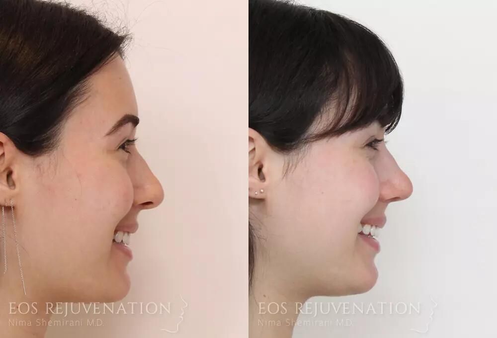 Rhinoplasty Before & After