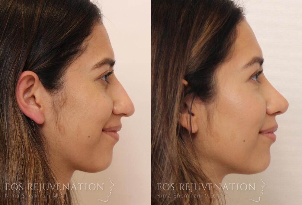 Rhinoplasty Before & After