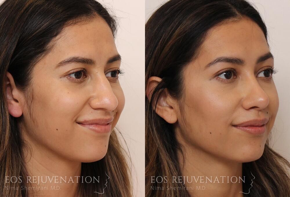 Rhinoplasty Before & After