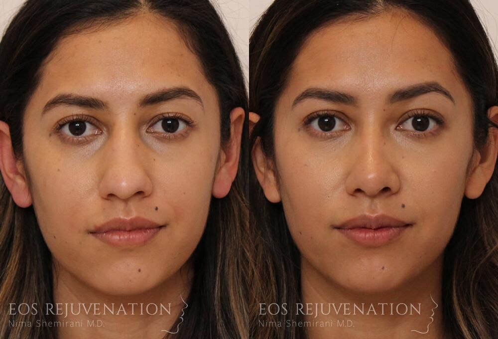 Rhinoplasty Before & After