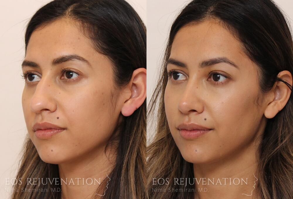 Rhinoplasty Before & After