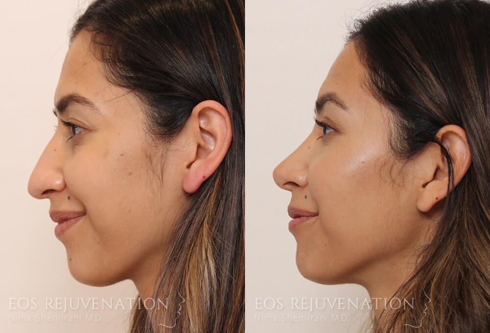 Rhinoplasty Before & After