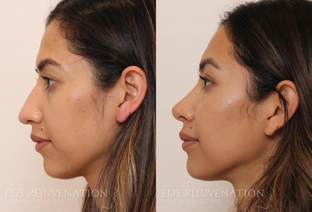 Rhinoplasty Before & After