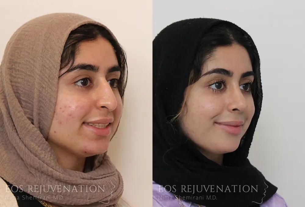 Rhinoplasty Before & After