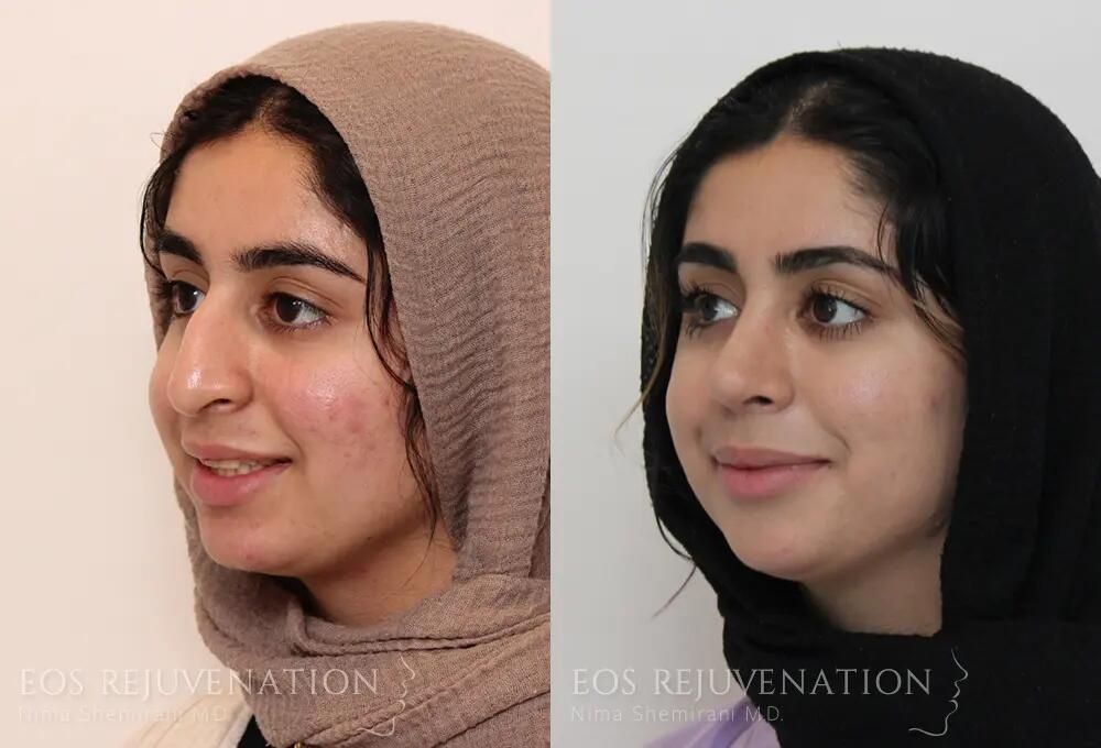 Rhinoplasty Before & After