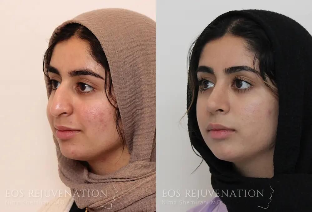 Rhinoplasty Before & After