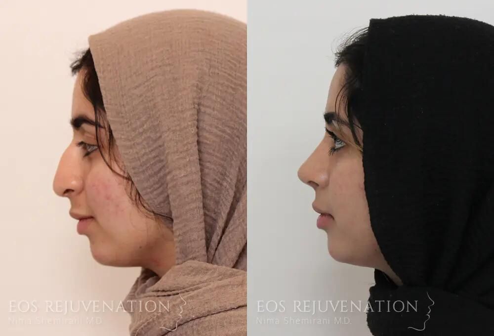 Rhinoplasty Before & After