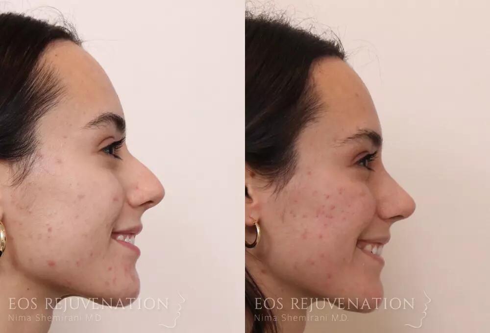 Rhinoplasty Before & After