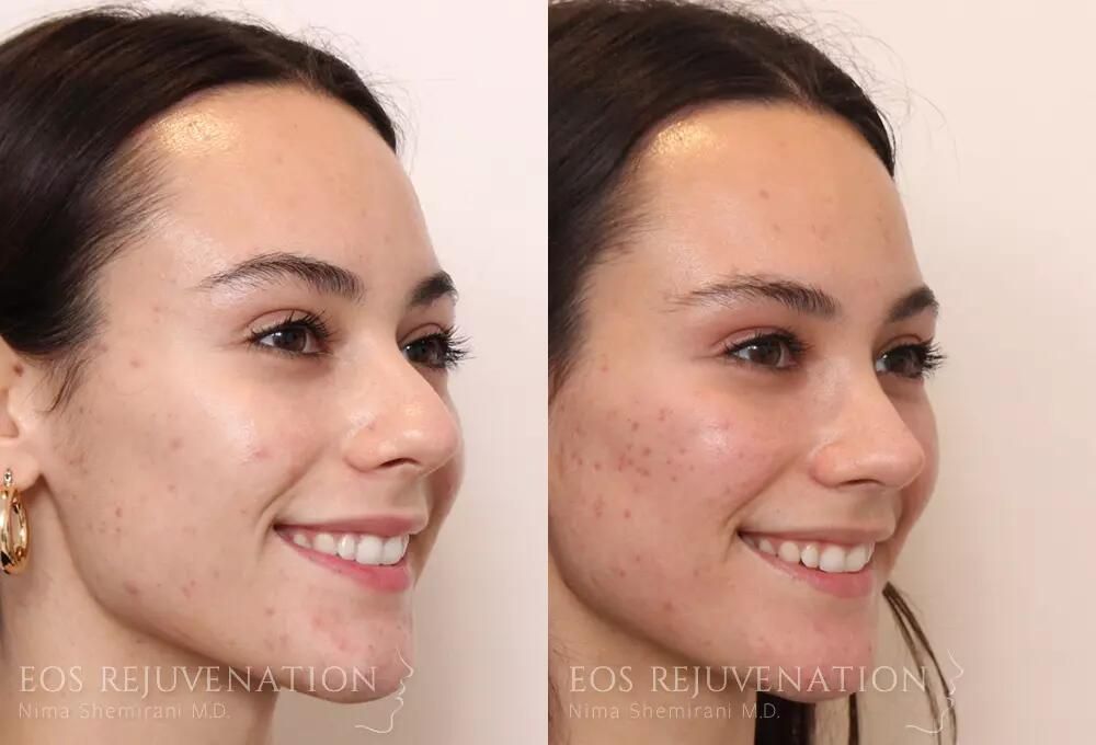 Rhinoplasty Before & After