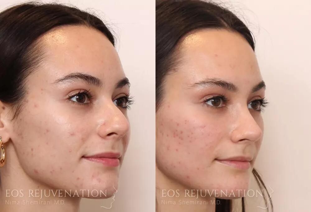 Rhinoplasty Before & After