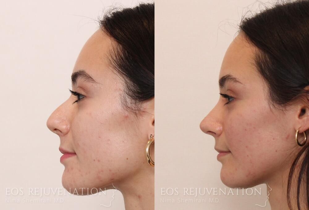 Rhinoplasty Before & After