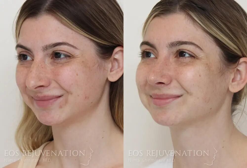 Rhinoplasty Before & After