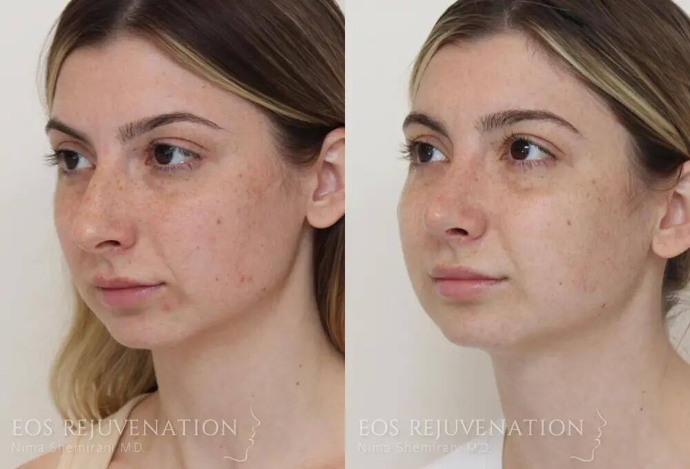 Rhinoplasty Before & After