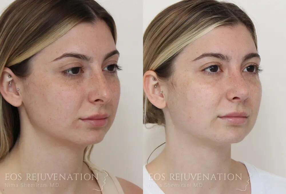 Rhinoplasty Before & After