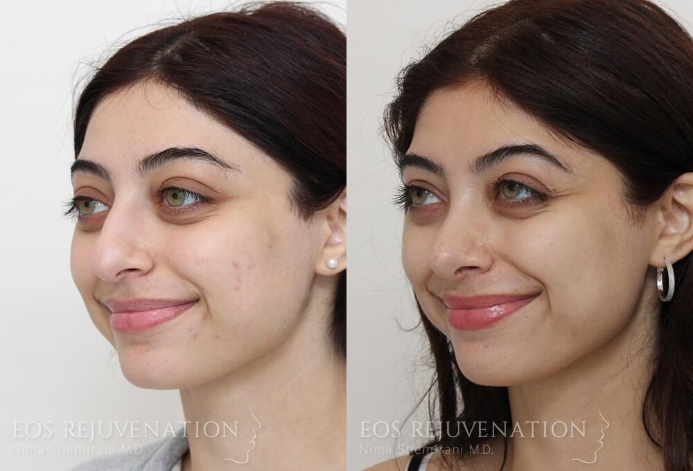 Rhinoplasty Before & After