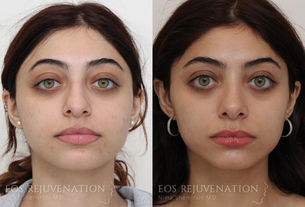 Rhinoplasty Before & After