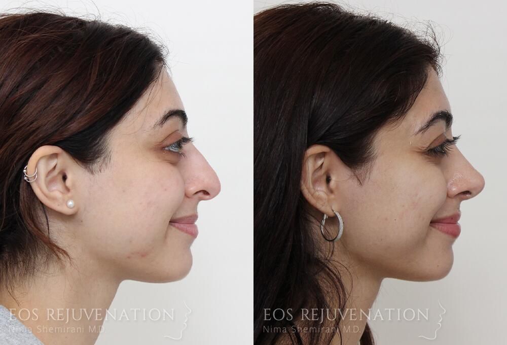 Rhinoplasty Before & After