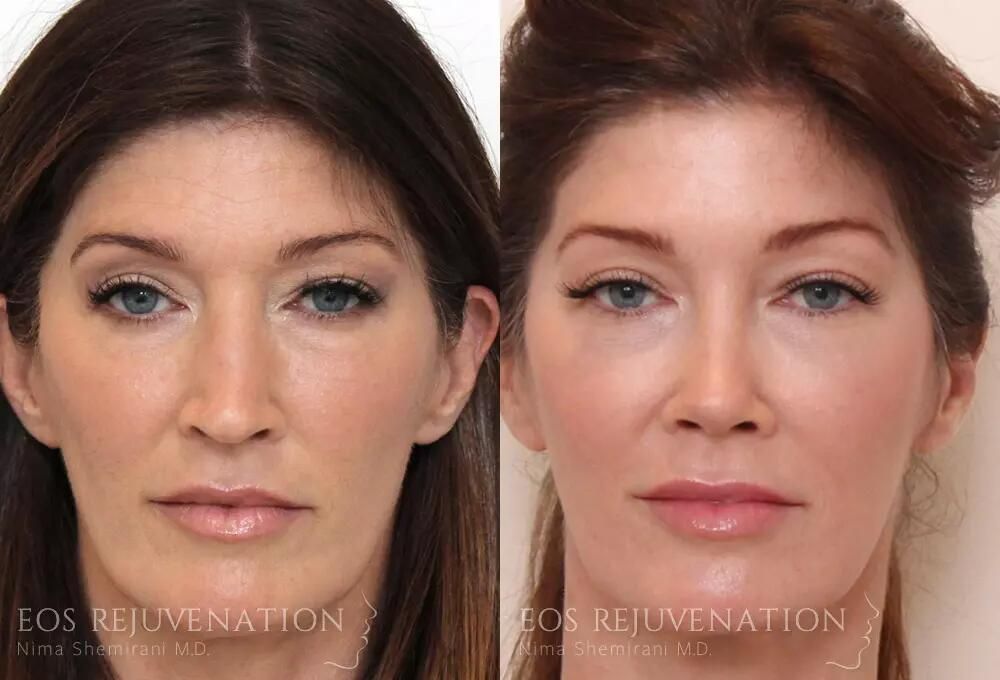 Rhinoplasty Before & After