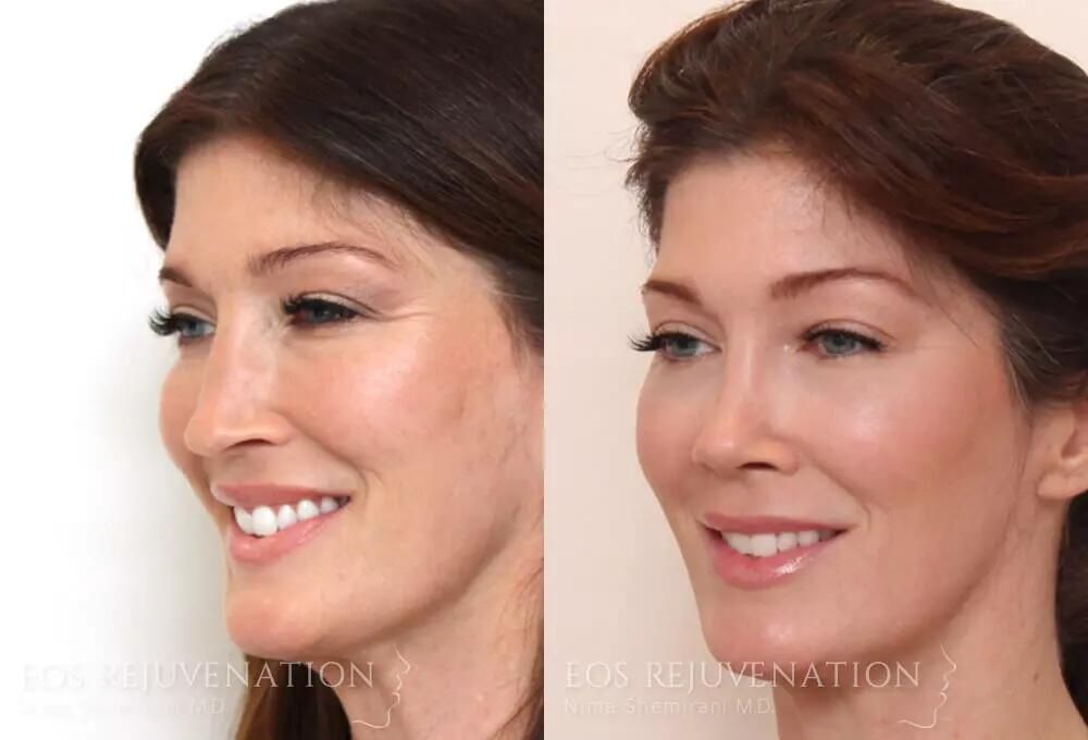 Rhinoplasty Before & After