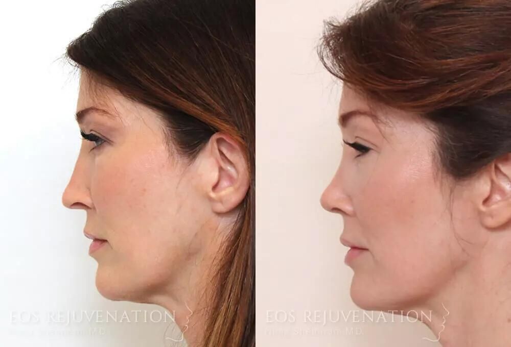 Rhinoplasty Before & After