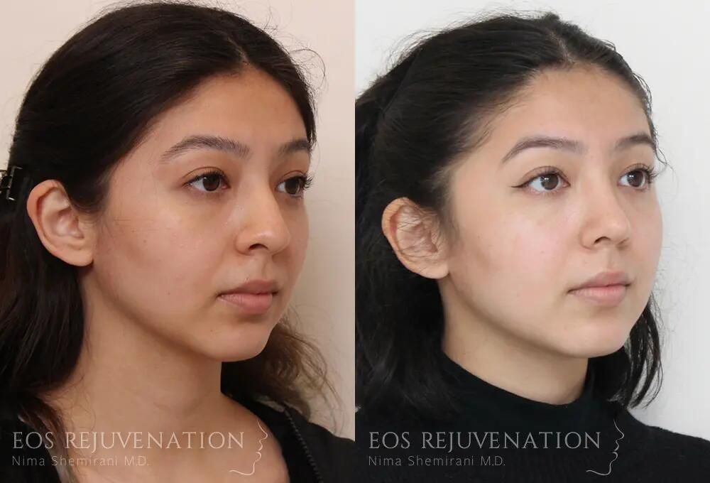 Rhinoplasty Before & After