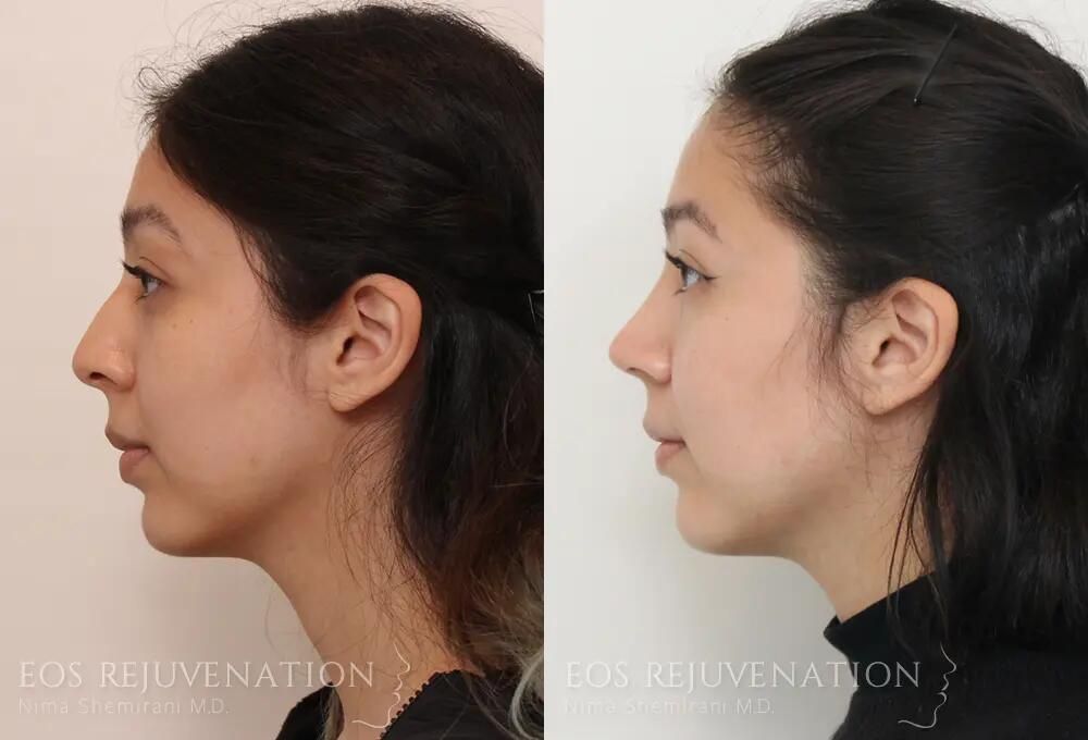 Rhinoplasty Before & After